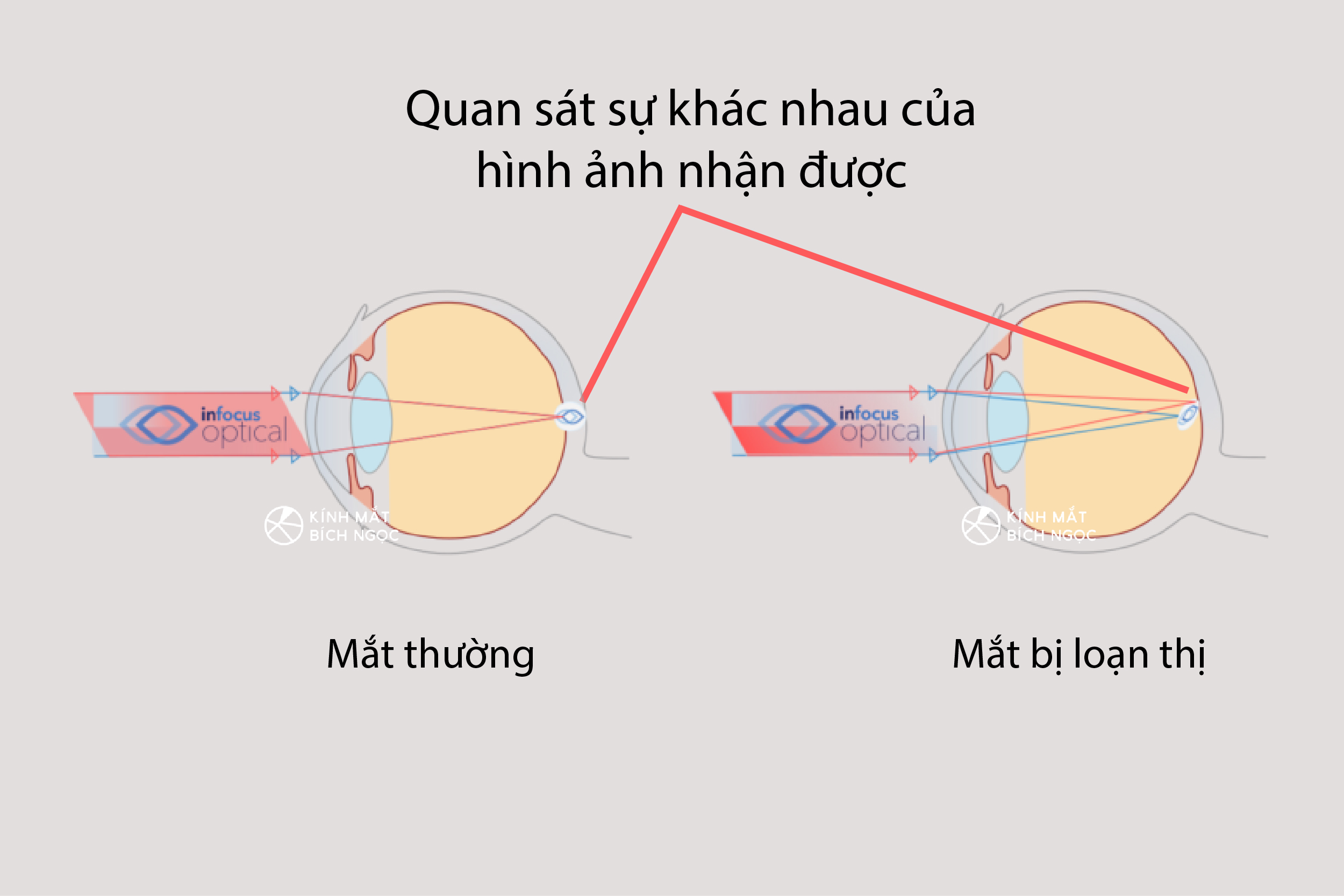 kính áp tròng viễn thị dùng hàng ngày