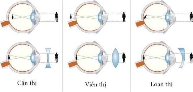 kính áp tròng viễn thị dùng hàng ngày